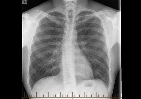 Pulmonary Fibrosis Vs Normal Lung