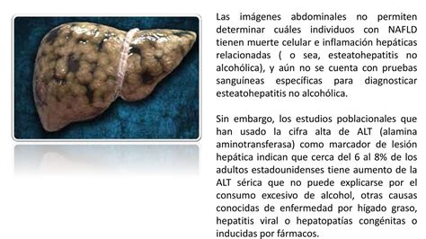 Hepatopatía Grasa No Alcohólica Y Esteatohepatitis No Alcohólica Ppt