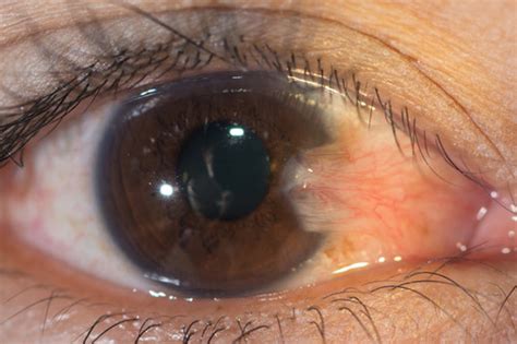 What Is Pterygium Eye Definition Treatment Surgery Health And