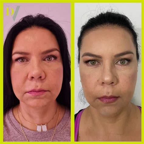 Hidroxiapatita C Lcica Redensificaci N Facial