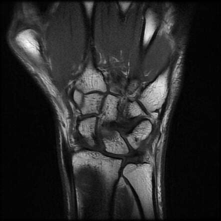 Ganglion cyst - wrist | Radiology Case | Radiopaedia.org