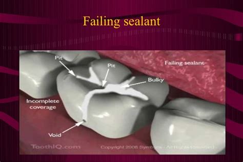 Pit and fissure sealants