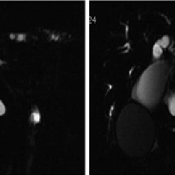 Breath Hold T2 Weighted Image Of The Coronal Plane Was Obtained Using