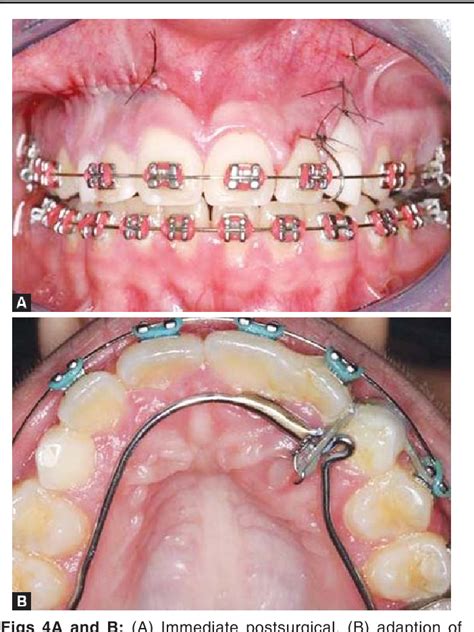 Figure 2 From Root Resorption Of Maxillary Incisors Caused By