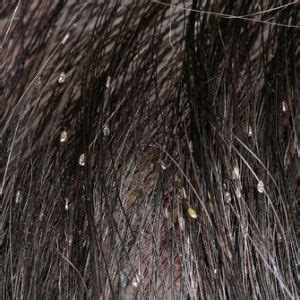 Head Lice Syn Pediculosis Capitis