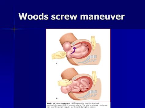 Shoulder Dystocia Woods Screw Maneuver