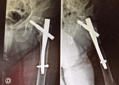 Tratamiento De Las Fracturas De Cadera Opción Médica