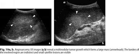 Hepatic Angiosarcoma HAS MRI Of The Liver Doctor Steve Abel