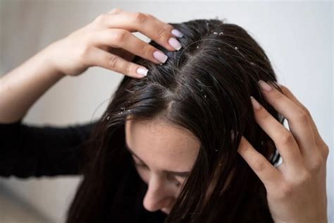 Best Dandruff Treatment That Will Cure Your Inner Health Of Hair