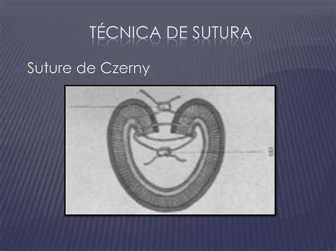 Seminario Anastomosis Intestinales PPT