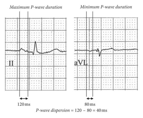 P-wave dispersion measured as difference between (a) maximum P-wave ...