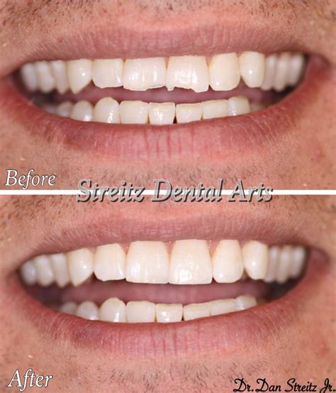 Cosmetic Bonding in Joliet and Plainfield | Streitz Dental Arts