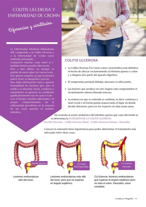 Diferencias Entre Enfermedad De Crohn Y Colitis Ulcerosa FUNDECCU