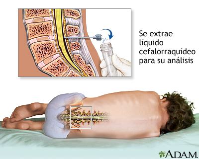 Prueba De Fijaci N Del Complemento Para Coccidioides En Lcr