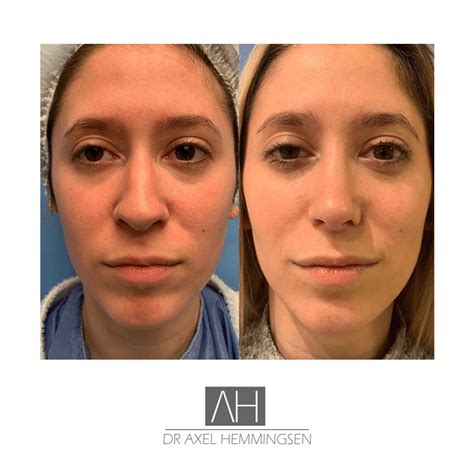 Rinoplastia Precio Argentina Axel Hemmingsen Buenos Aires