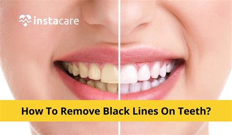 How To Remove Black Lines On Teeth