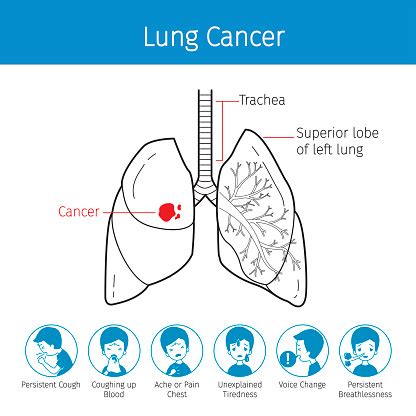 Illustration Of Human Lungs Outline And Lung Cancer Symptoms Icons Stock Illustration - Download ...