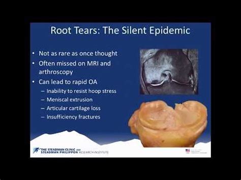 What is a meniscus root tear why repair a meniscus root tear knee ...