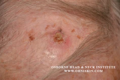 Basal Cell Carcinoma Scalp Surgery