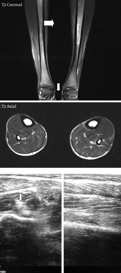 Tibial Stress Fracture Mri