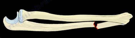 Ulna Dr Nabil Ebraheim S Blog