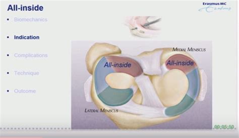 All Inside Meniscal Repair OrthopaedicPrinciples