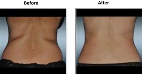 Back Braline Aesthetics Face And Bodysculpting