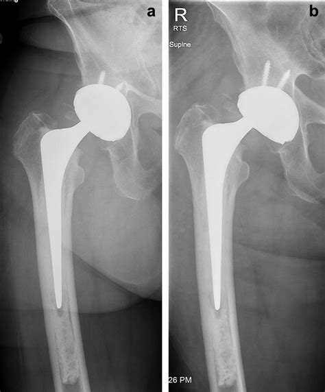 A Six Week Postoperative Radiograph Of Modular Dual Mobility Cup In