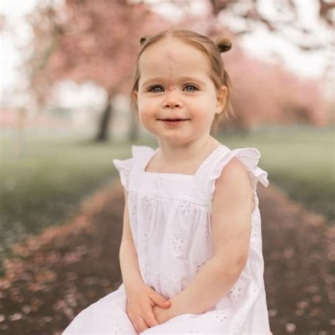 Das Baby Wurde Mit Einem Gro En Muttermal Im Gesicht Geboren Es Wurde