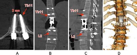 Results Of Postoperative Spiral CT Of The Thoracolumbar Transition Of