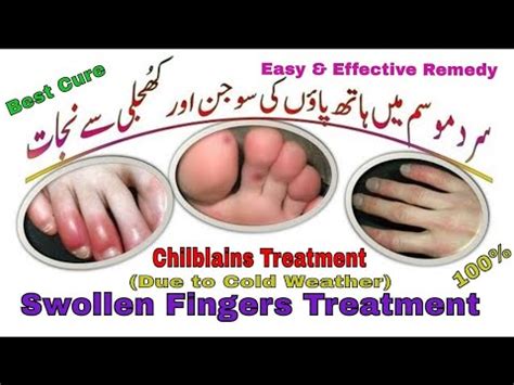 Sardi Main Hath Or Pao Ki Sujan Ka Ilaj Chilblains Treatment YouTube