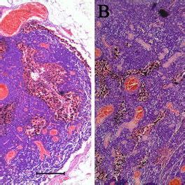 Haematoxylin And Eosin HE Stains 4 10 Of Axillary Lymph Nodes