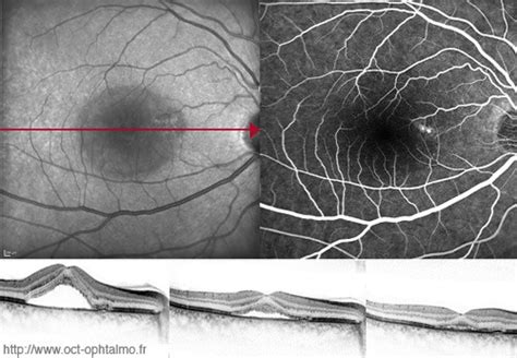 LOCT ou Tomographie en Cohérence Optique Docteur Jerome Madar