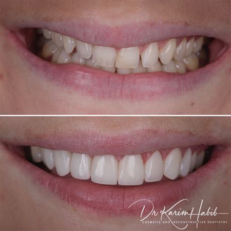 Composite Veneers Sydney Dental Bonding Sydney Dentist Ryde