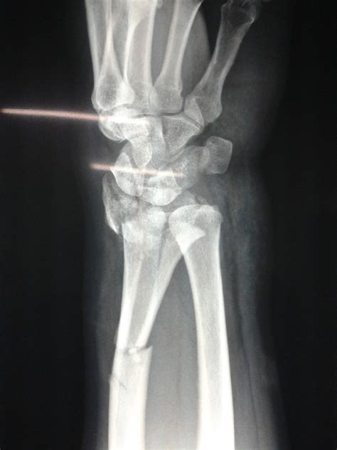 Distal radius fracture - lostbrasil