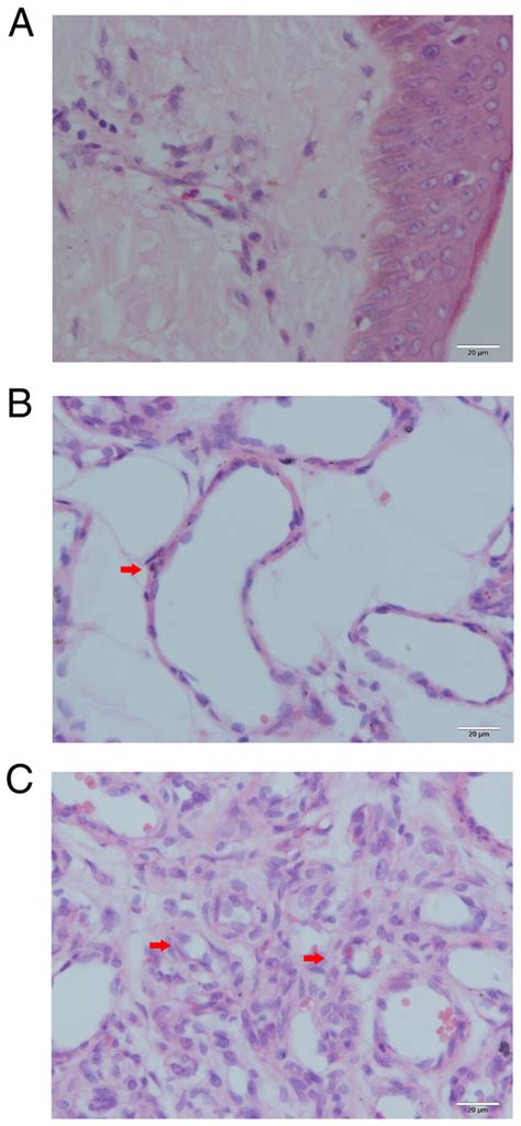 Histopathological Analysis Of Hemangioma Tissues A Normal Skin B