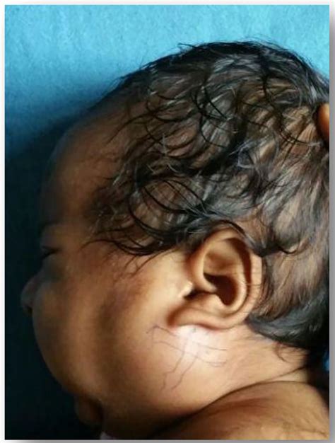 Parotid Gland Swelling Children