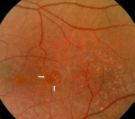 Full thickness macular defect following epiretinal membrane peel. | Download Scientific Diagram