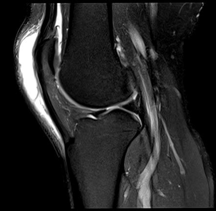 Prepatellar Bursitis Radiology Case Radiopaedia Org