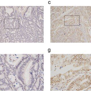 Representative Immunohistochemical Images Of PFKFB4 Expression In COAD