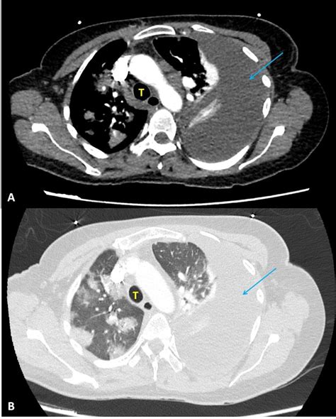 Tension Hydrothorax In A Patient With Sars Cov Pneumonitis And