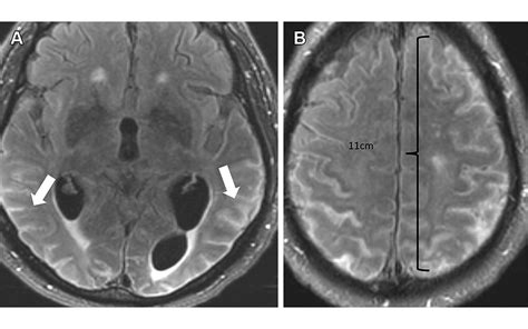 Aria In Lacanemab Donanemab And Aduhelm Alzweek