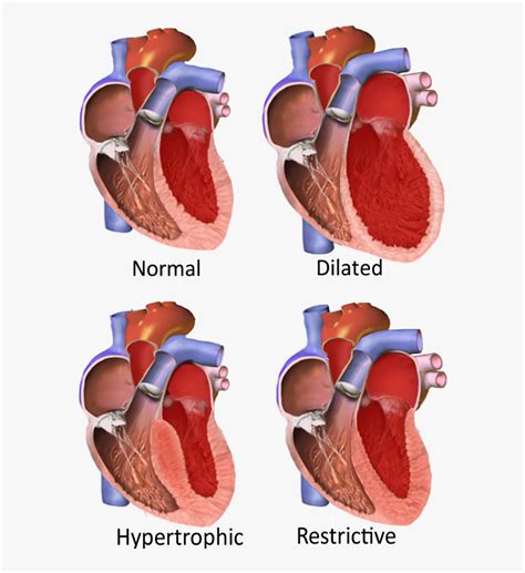 Major Categories Of Cardiomyopathy Different Cardiomyopathies HD Png