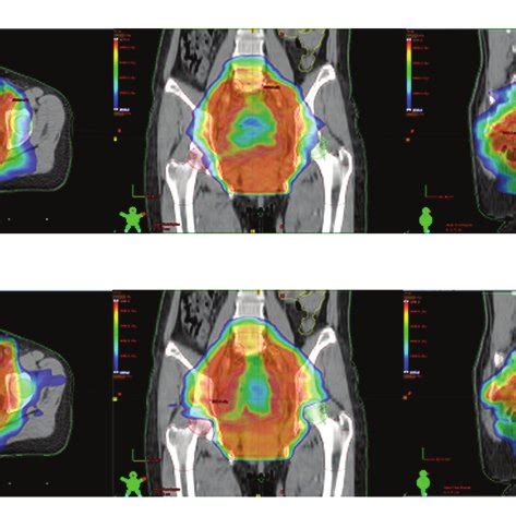 Dose Volume Histogram Of A Representative Patient For Vmat And Imrt