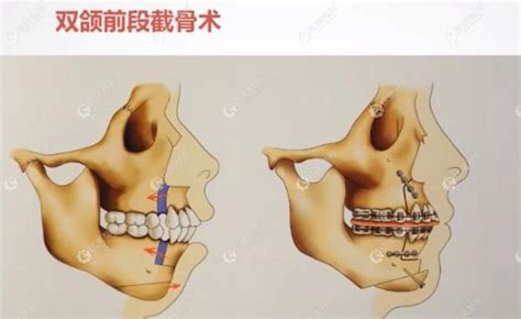 重庆正颌手术费用多少 重庆松山等医院给出凸嘴正颌价格6万起整形案例 重庆松山医院 炫美网