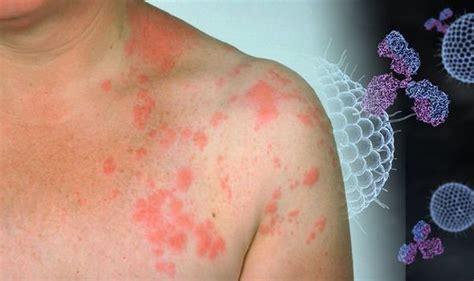 Shingles: This type of rash may reveal you’ve been infected with the ...