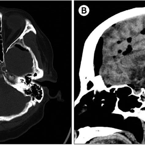 Brain Computed Tomographic Image Diffuse Pneumocephalus Axial View