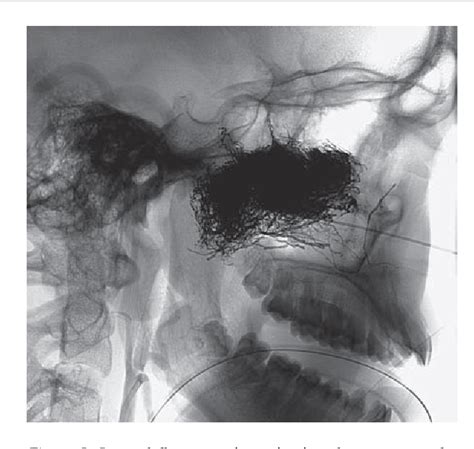 Figure From Direct Endoscopic Intratumoral Injection Of Onyx For The