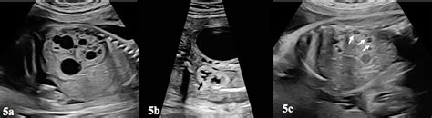 Frontiers Prenatal Diagnosis And Findings In Ureteropelvic Junction