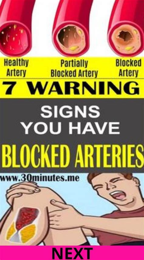 Here Are Warning Signs You Have Blocked Arteries Artofit